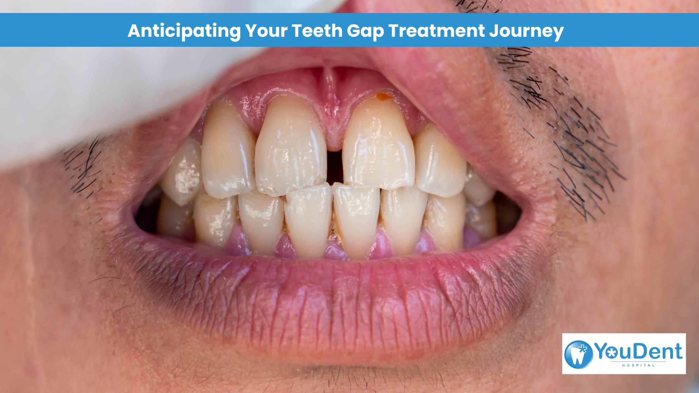 Anticipating Your Teeth Gap Treatment Journey