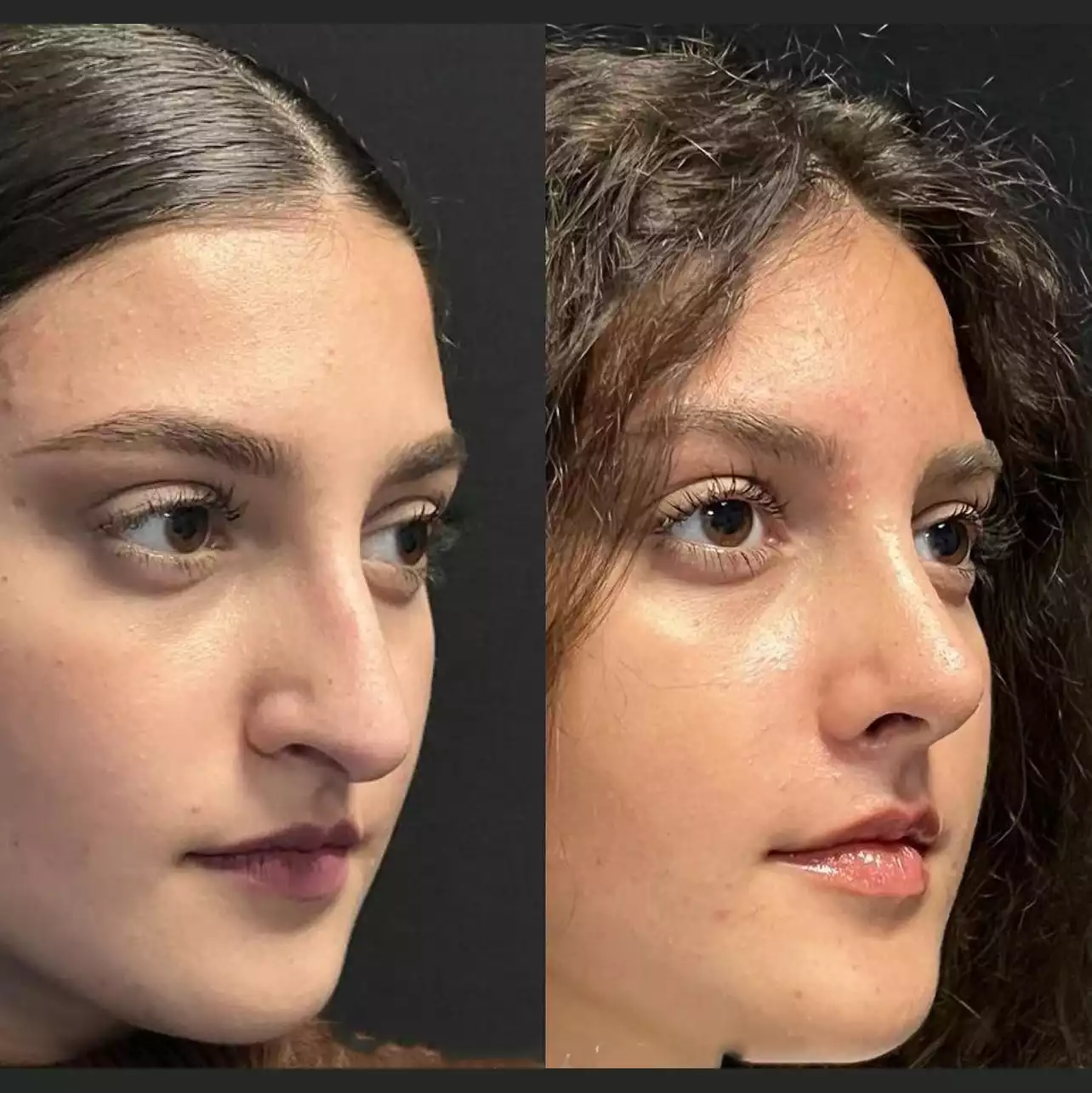 Enhancing Confidence Through Nose Surgery in Dubai