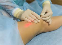 Laser treatment for varicose veins
