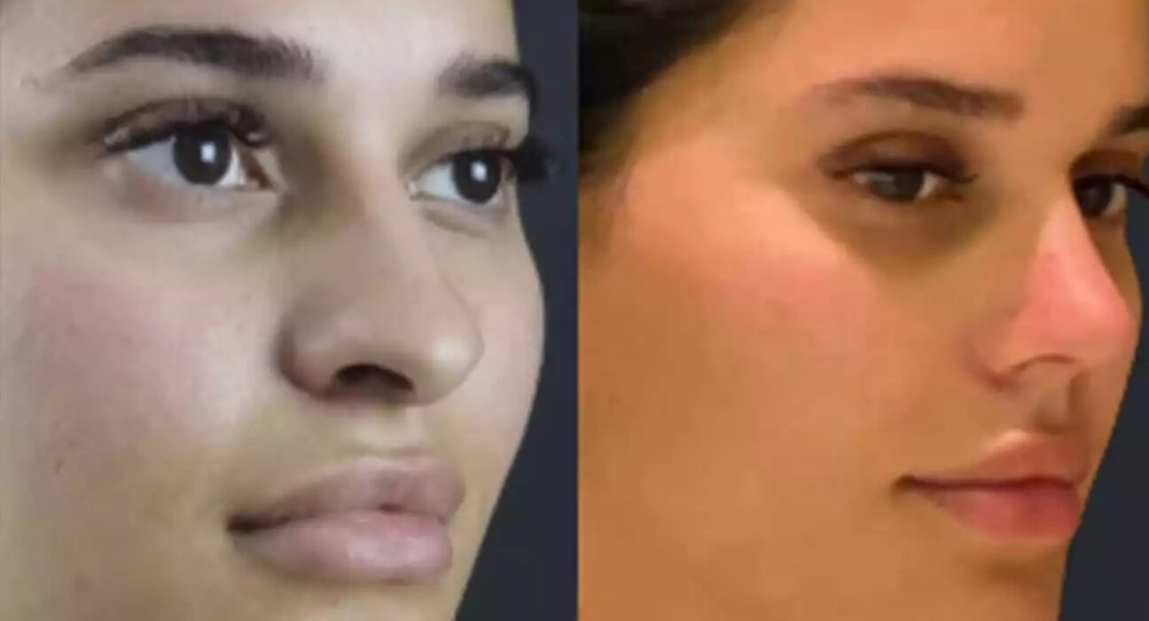 septoplasty in dubai
