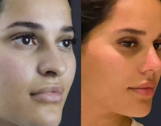 septoplasty in dubai