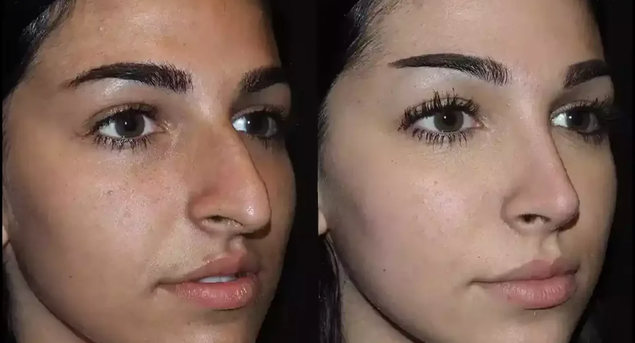Exploring the Benefits of Rhinoplasty in Dubai