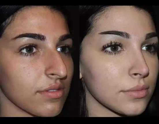 Exploring the Benefits of Rhinoplasty in Dubai