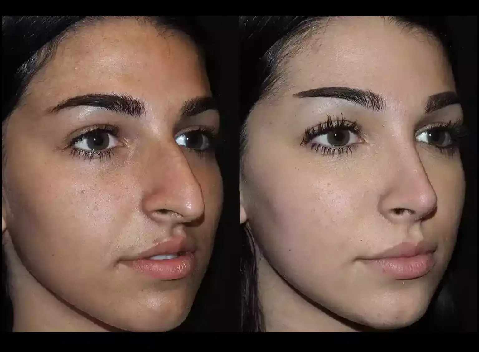 Exploring the Benefits of Rhinoplasty in Dubai