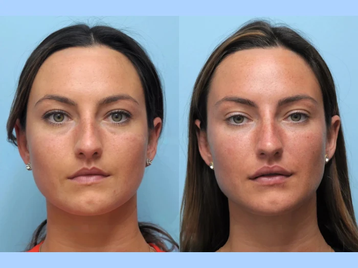 Natural Rejuvenation with Thread Lift in Dubai