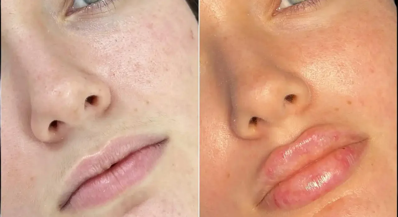 Fillers in Dubai