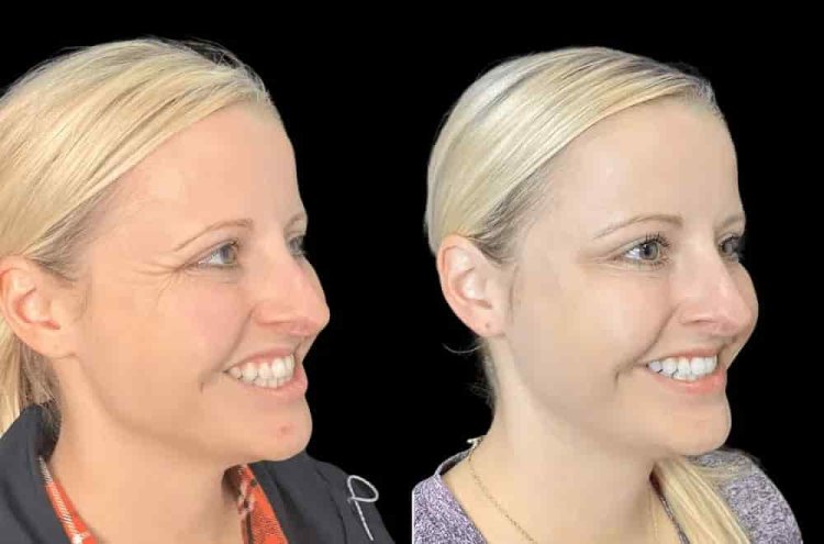 Your Skin Deserves the Best Aesthetic Clinic in Dubai for Botox