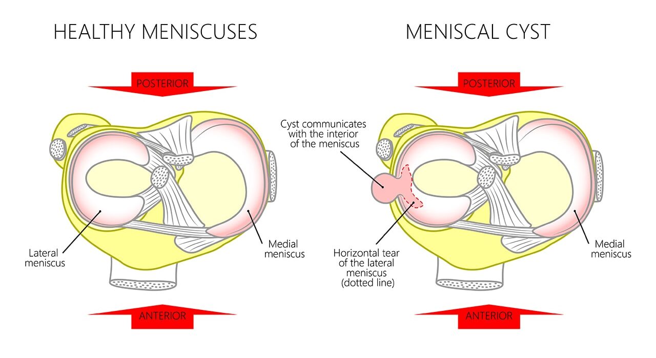Meniscal Cyst