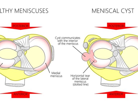 Meniscal Cyst